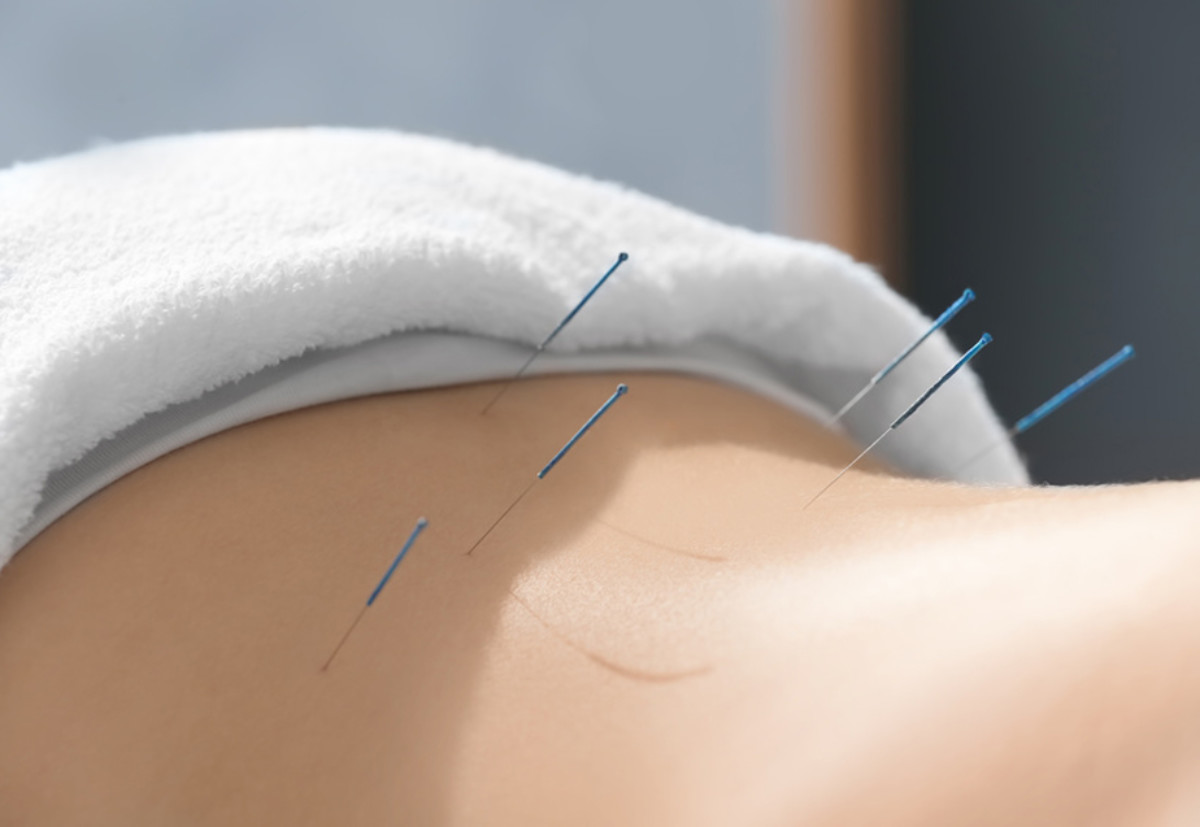 Sanfte Nadeltherapie